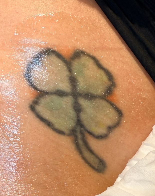Four-leaf clover tattoo before treatment