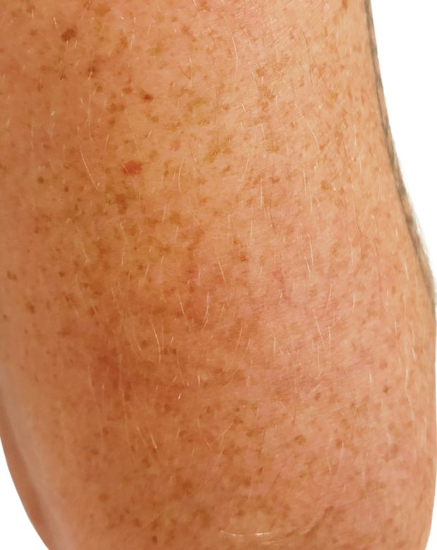 The same leg after treatment