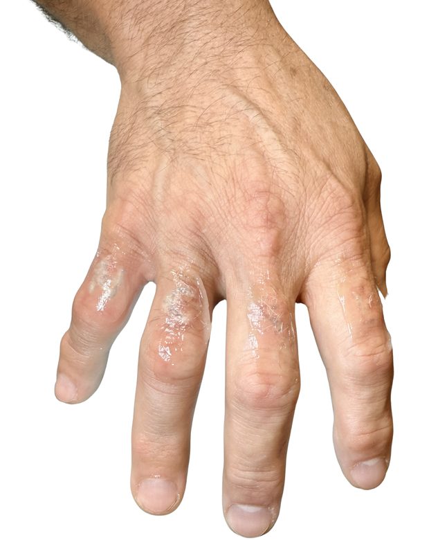 The same hand after treatment