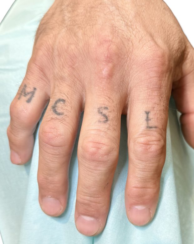 Lettering tattooed across the fingers before treatment