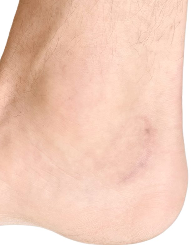 The same ankle after treatment